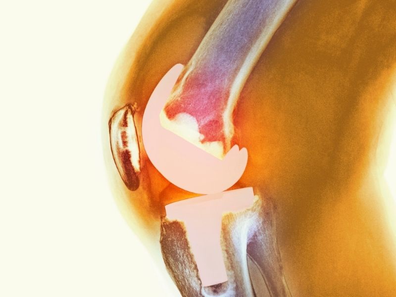 Tratamento Conservador para Artrose do Joelho em Curitiba